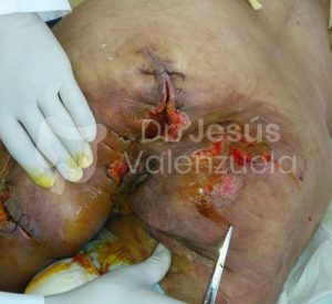 tratamiento absceso perianal muslo en guadalajara